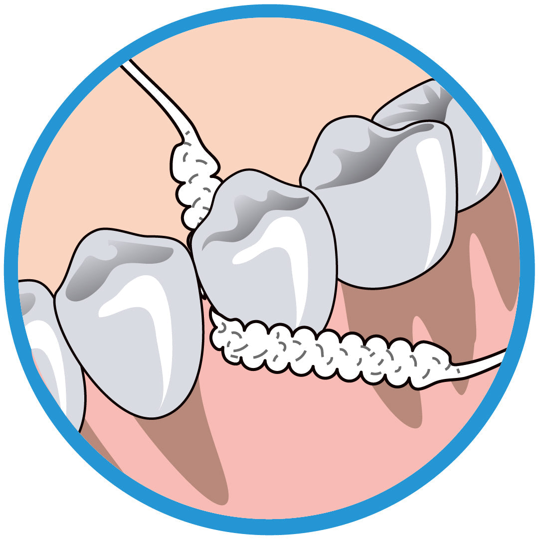 Illustration of Oral-B Superfloss cleaning between teeth and under gumline