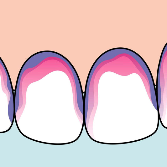 Illustration showing two-tone plaque staining on teeth using Tepe Plaque Search disclosing tablets highlighting new red plaque and older blue plaque.