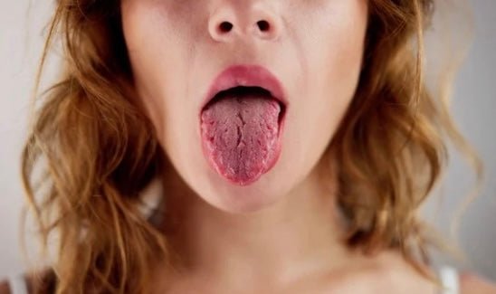 Dry Mouth (Xerostomia): What It Is and How to Manage It