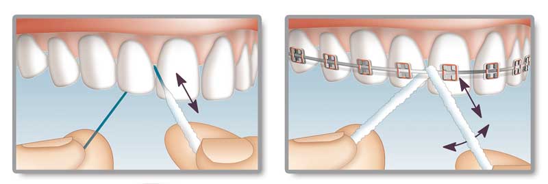 Illustration showing the use of Oral-B Superfloss to clean between regular teeth and around braces with pre-cut floss strands.