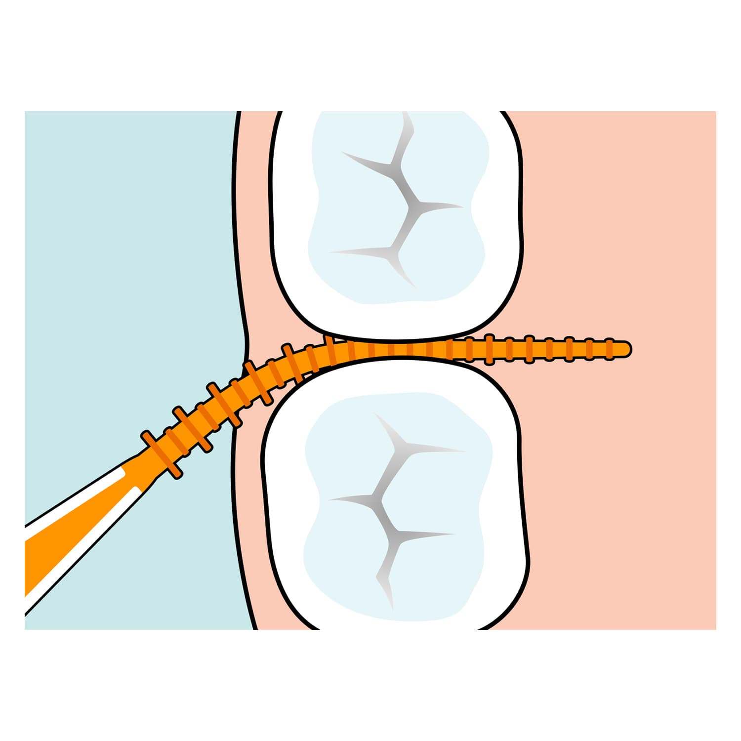 Illustration of TePe Easypick with travel case cleaning between teeth to remove plaque and debris