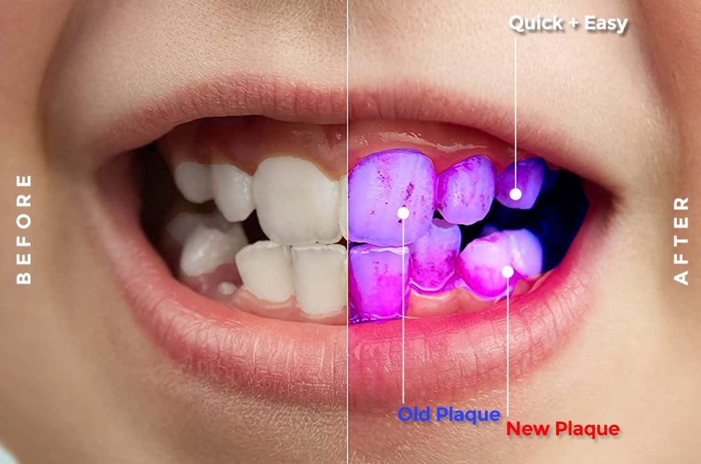 Close-up of teeth showing before and after using Tepe Plaque Search disclosing tablets highlighting new red plaque and old blue plaque for dental hygiene.